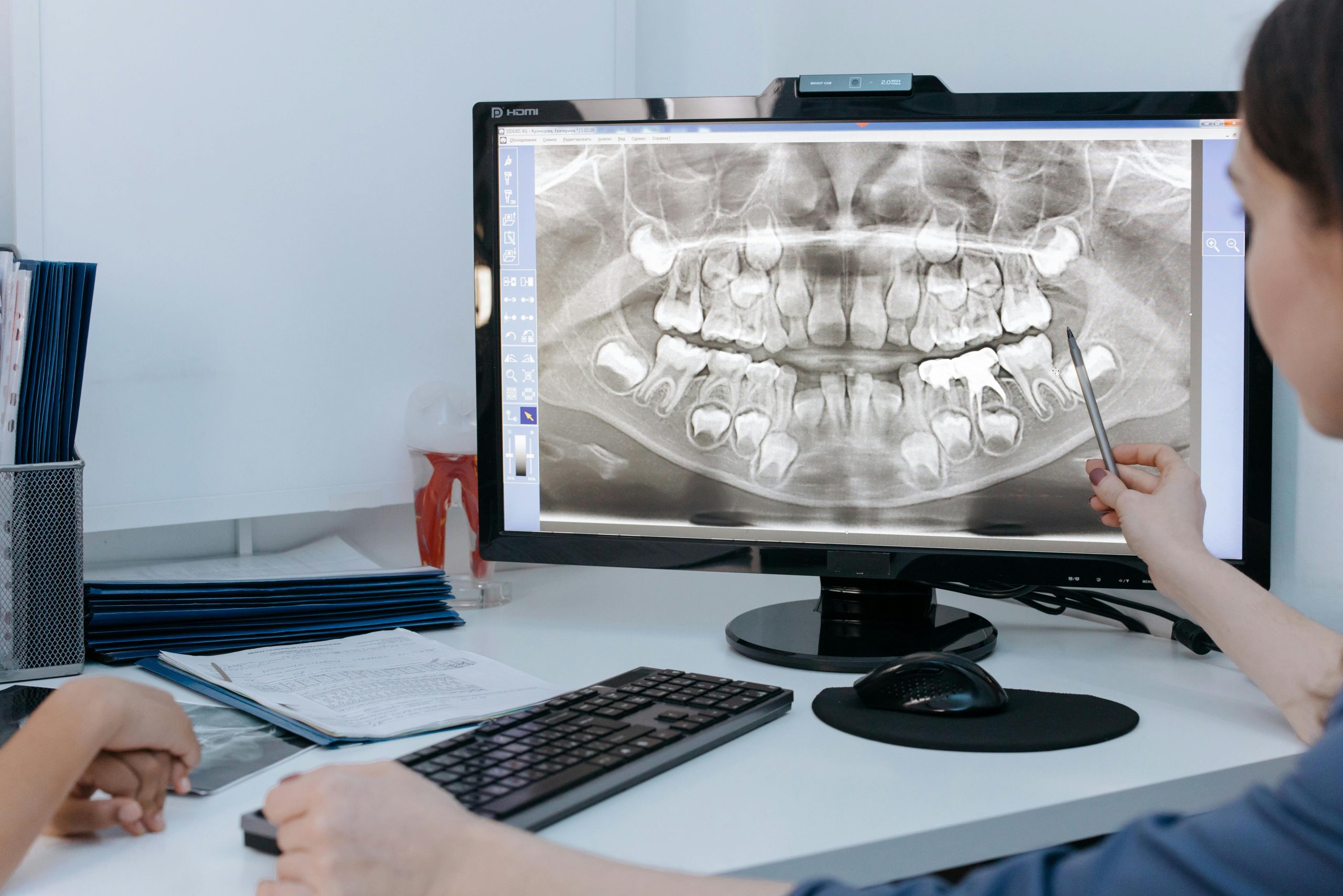 Jaw Fracture